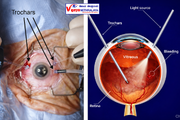 Vitrectomy Operation