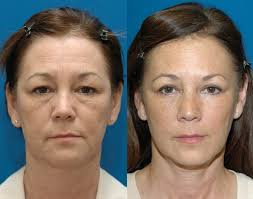blepharoplasty surgery