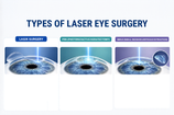 Types of Laser eye Surgery