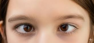 Squint Eye